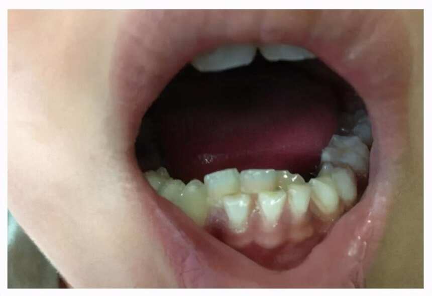 你的孩子有“双排牙”吗？宝妈这个行为，直接毁了孩子一口牙